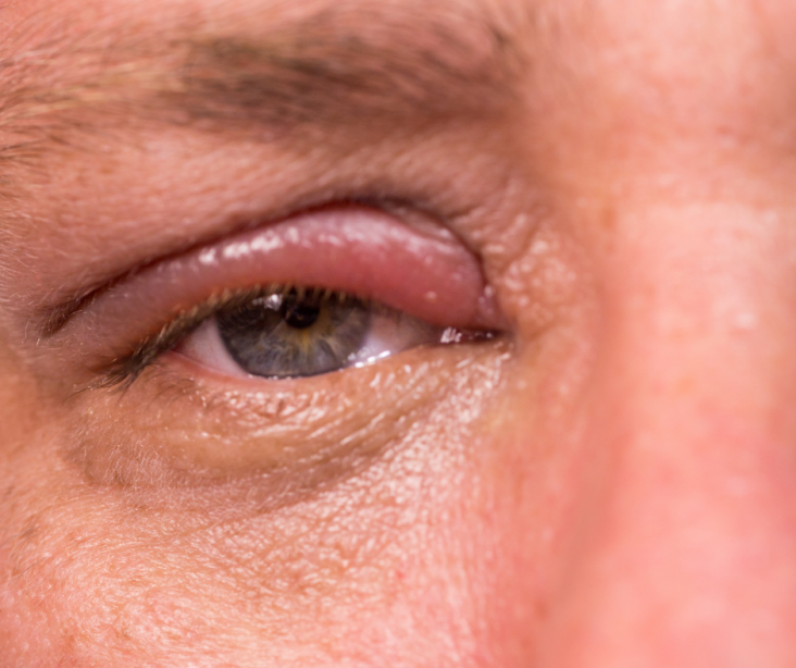 Qual a relação do terçol com a inflamação crônica das pálpebras? - Guia ...