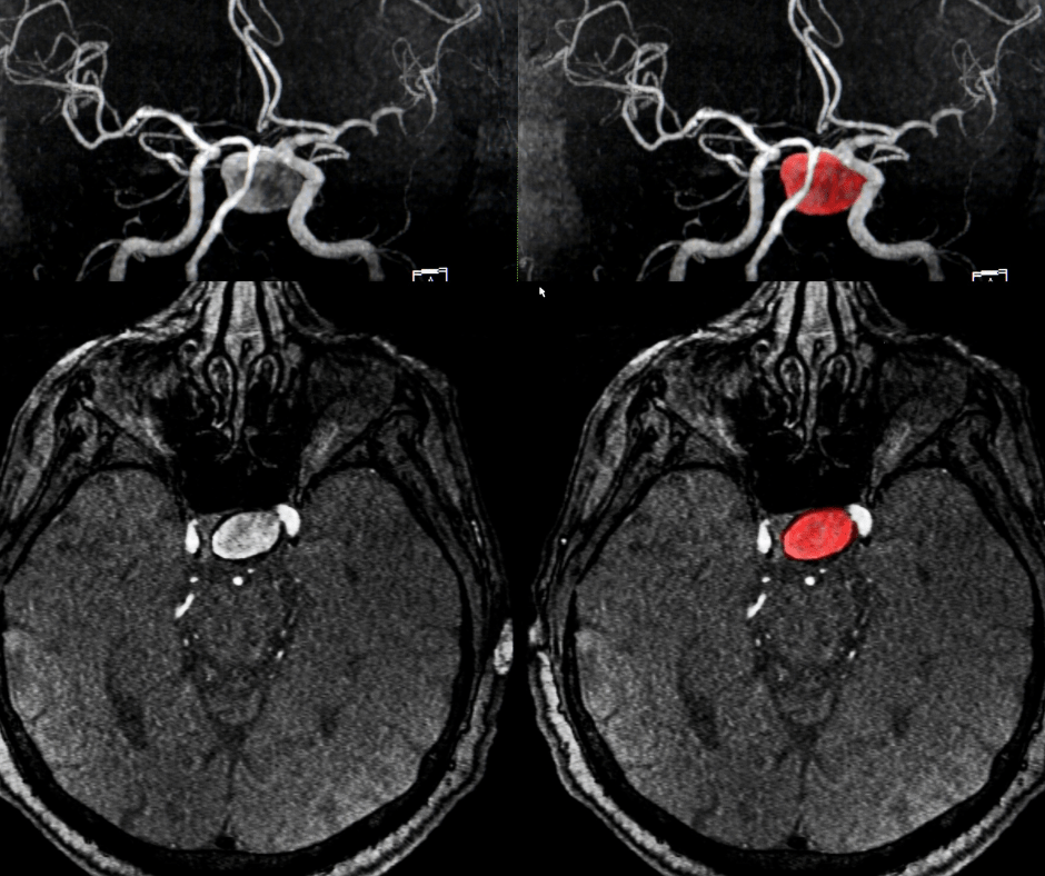 Aneurisma Cerebral Cerca De 3 A 5 Das Pessoas T m O Problema Guia Aneurisma Cerebral Cerca De 3 A 5 Das Pessoas T m O Problema Guia