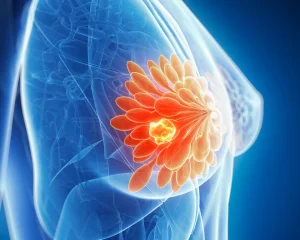 imagem de uma mama como se fosse uma tomografia e aparece a imagem de um tumor nas glandulas